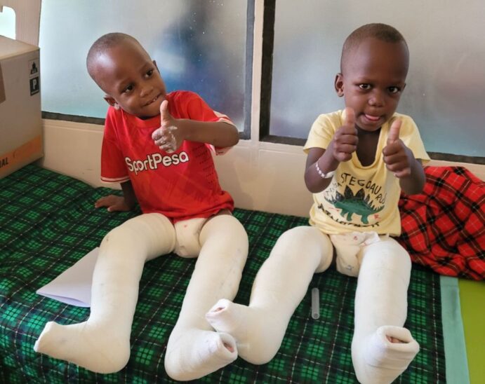 Die vierjährigen Zwillinge John und Jonathan mit eingegipsten Beinen nach dem erfolgreichen Eingriff.